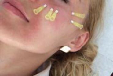 Jak leczyć kurzajki?